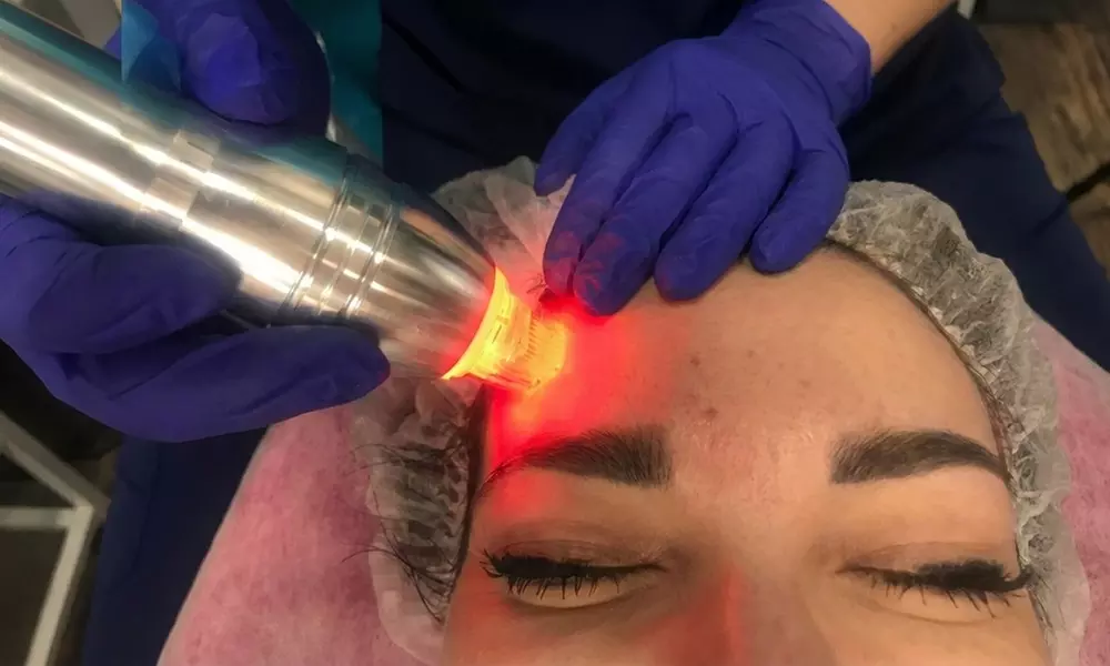 Odmładzająca radiofrekwencja mikroigłowa na twarz, szyję i dekolt