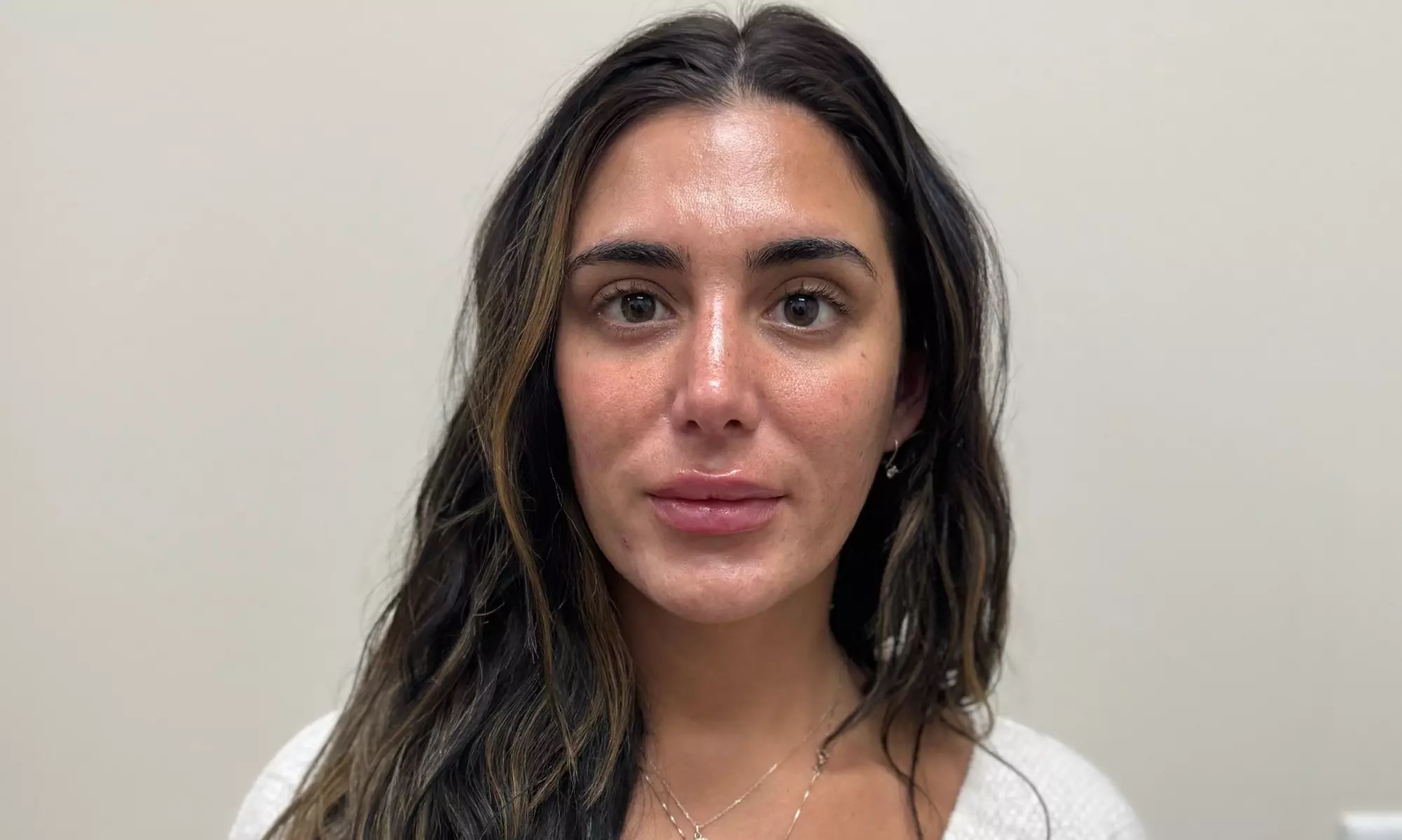 Botox Units (20–40) & Combo/Optional Lip Filler Syringe Injectables