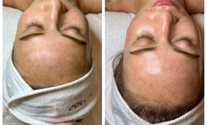 Image 3: Gesichtsbehandlung mit Microneedling / Augenbrauenkorrektur – 1 Person