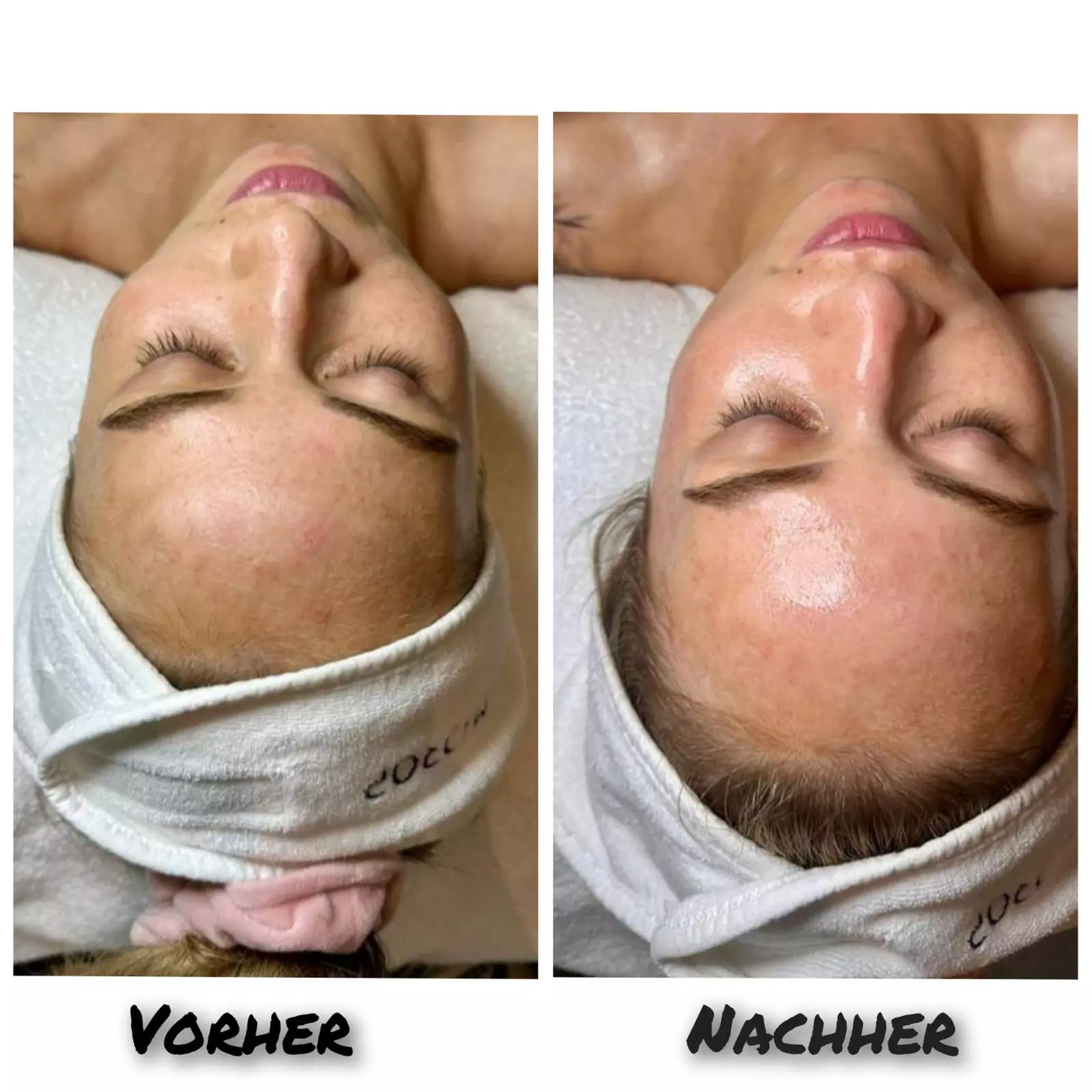 Gesichtsbehandlung mit Microneedling / Augenbrauenkorrektur – 1 Person