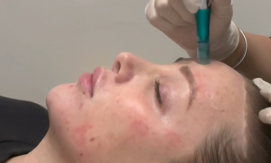 Image 2: One or Two Sessions of Microneedling or One or Three Sessions w/ Mask