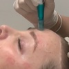 Image 2: One or Two Sessions of Microneedling or One or Three Sessions w/ Mask