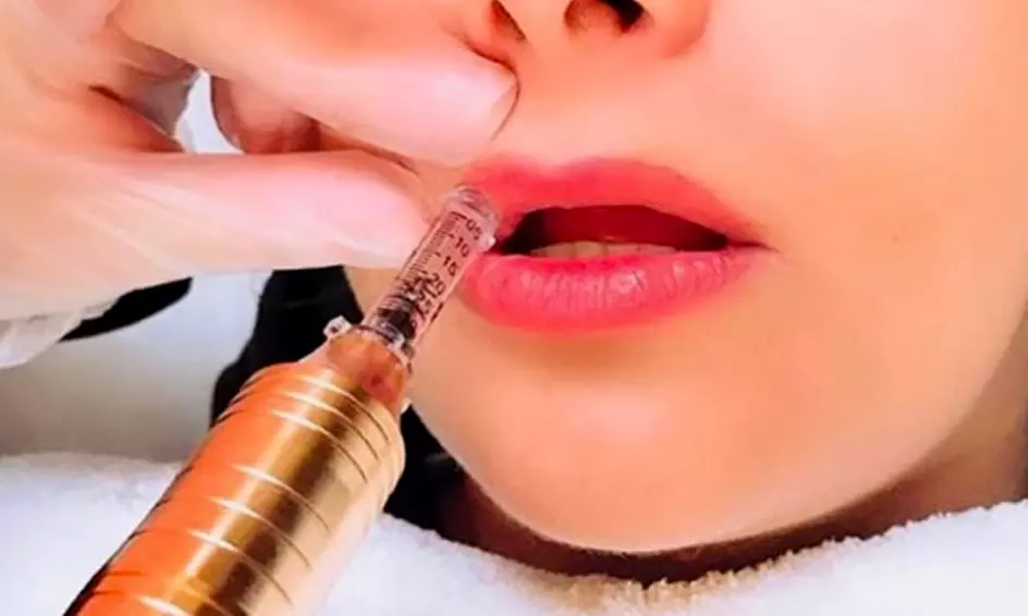 Get 1 or 2 ml of Lip Filler with Needle-Less Application