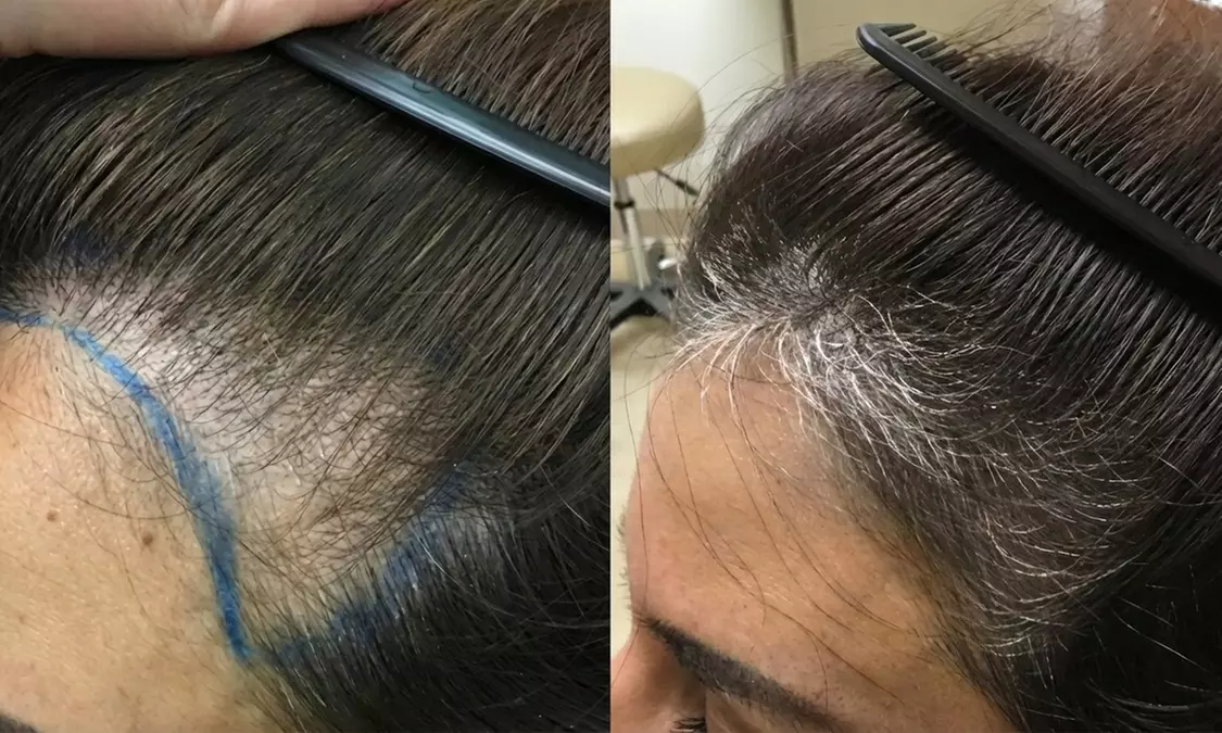 One, Two, Three or Six Sessions Of Medical PRP Hair Restoration