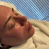 Image 1: 45 Min. Mikrodermabrasion / 60 Min. Mikrodermabrasion & Microneedling