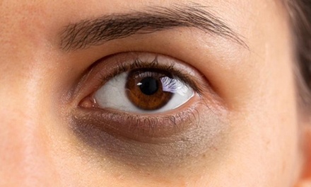 One session of Polynucleotides -Lumi Eyes treatment; - Regains Beauty & Aesthetics