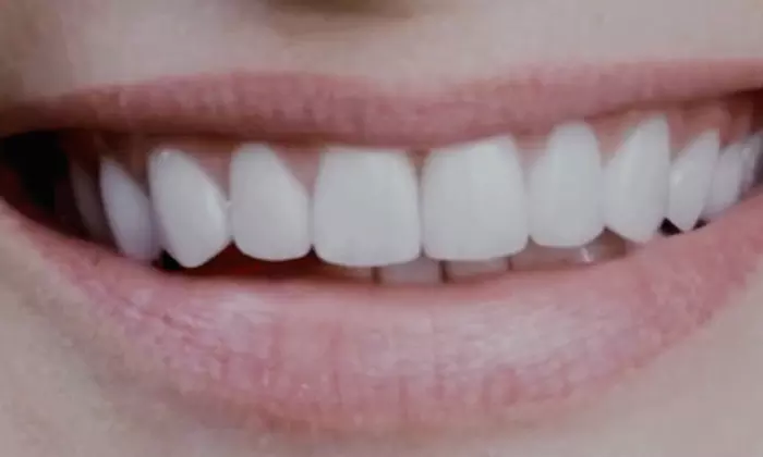 Dental Implant Consultation+3D CT Scan/$1,000.00 Toward Dental Implant
