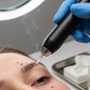 Image 1: One, Two, or Three Skin Tag Removal & Milia With Plasma Pen