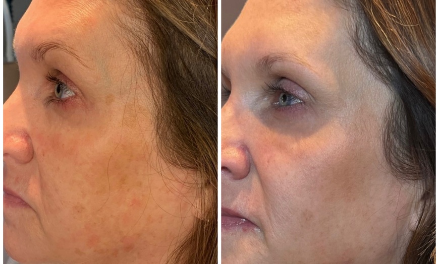 Image 3: ONLY Genuine BOTOX® 20, 40, or 60 Units!