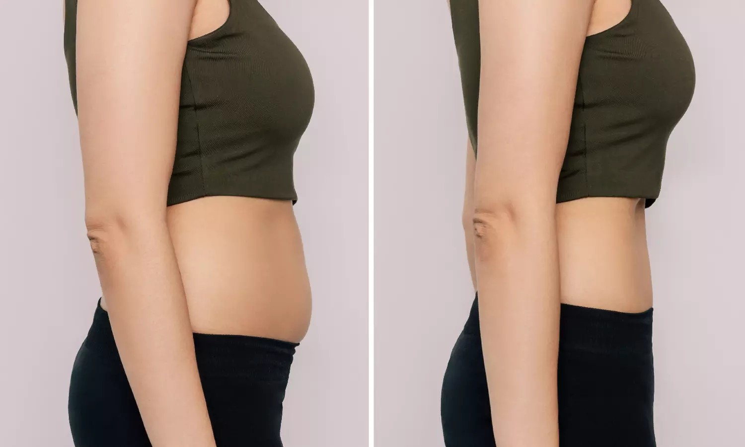 One Session RF Body Contouring with B12 Fat Burner
