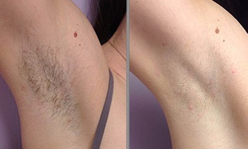 Image 2: Laser hair removal sessions at The MM Laser Clinic