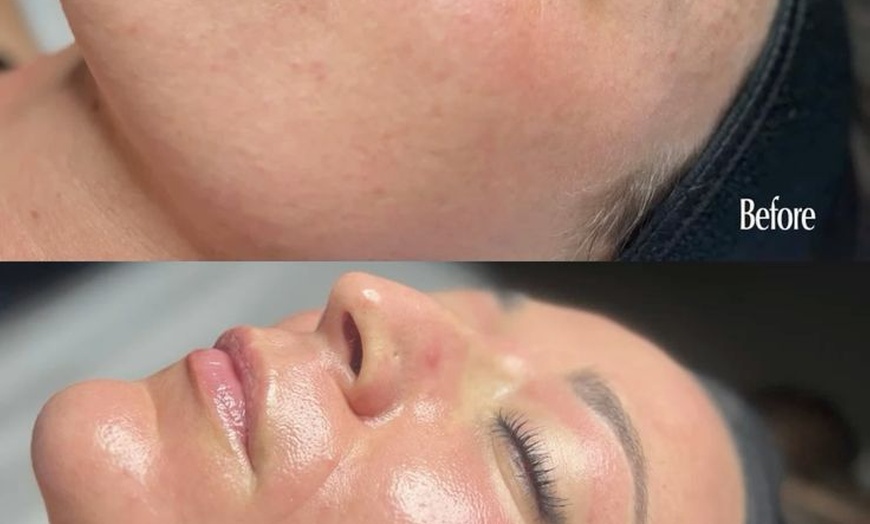 Image 12: Revitalize Your Summer Glow with Luxury Microdermabrasion Facial