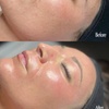 Image 12: Revitalize Your Summer Glow with Luxury Microdermabrasion Facial
