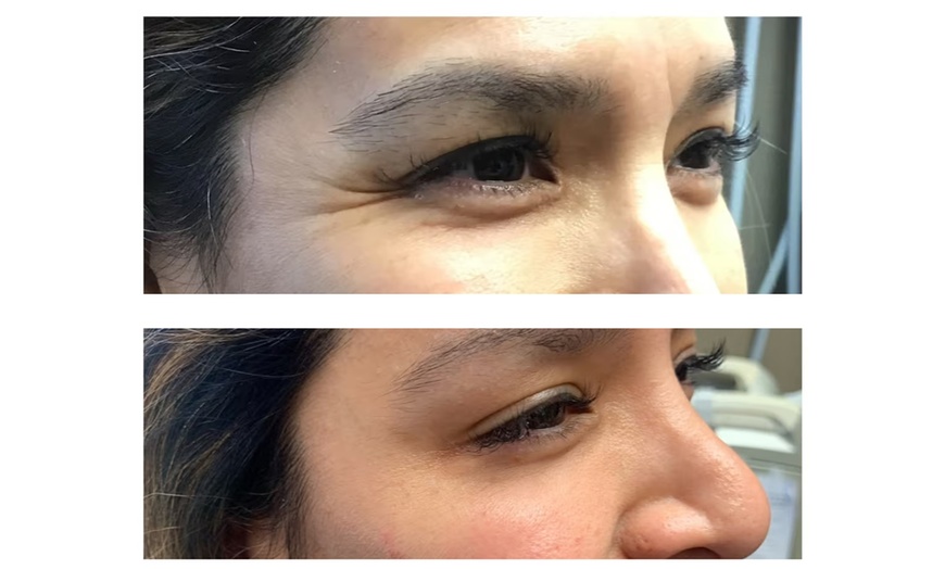 Image 3: Experience a Youthful Look with 20 Units of Botox