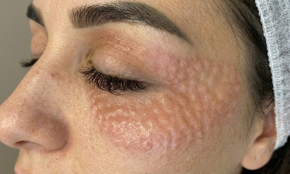 NCTF "Chanel Injection" or Rejuran "Salmon Sperm Facial