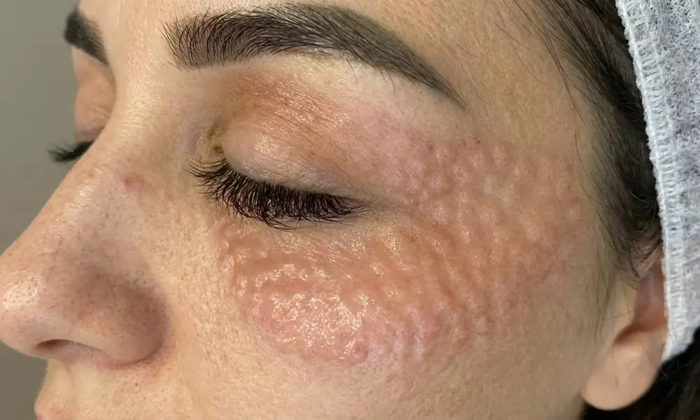 Rejuvenate with NCTF "Chanel Injection" or Rejuran "Salmon Sperm Facial" for Face & Under-Eye (Up to 20% Off) - Primary Image