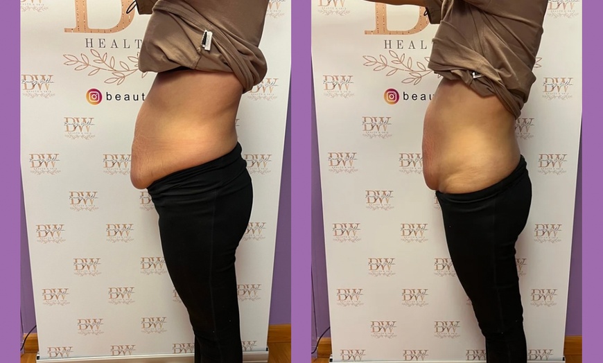 Image 3: One, Three, or Six Mommy Makeover Sessions or Snatched To The Max