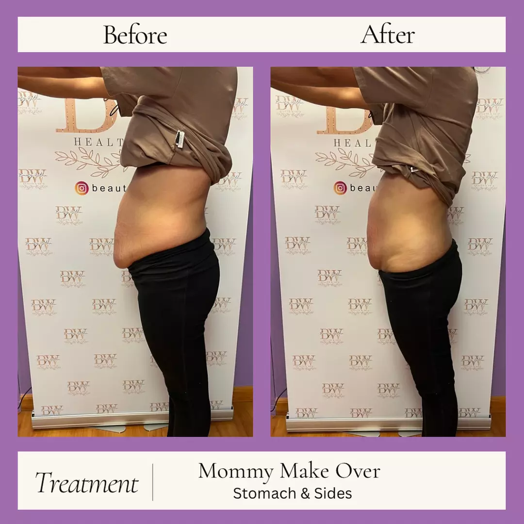 One, Three, or Six Mommy Makeover Sessions or Snatched To The Max