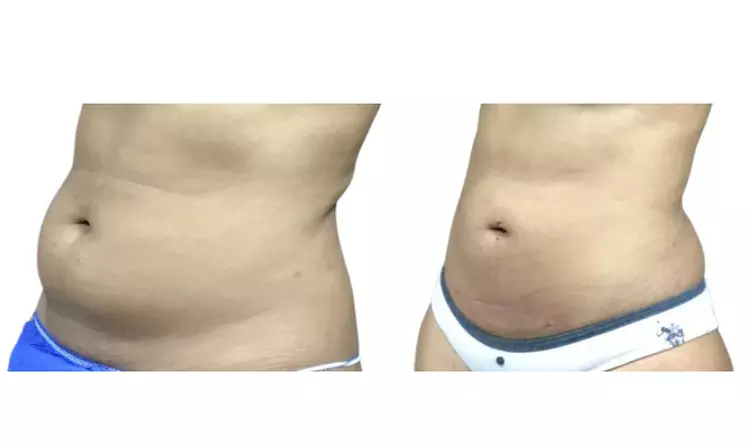 SmartLipo Triplex Laser Assisted Liposuction