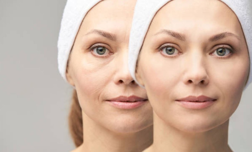 Image 7: Infiltración de 1 o 2 viales de tratamiento de relleno facial para 1