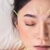 Image 3: Relieve with One, Two or Three 60 Min Choice of Acupuncture Sessions