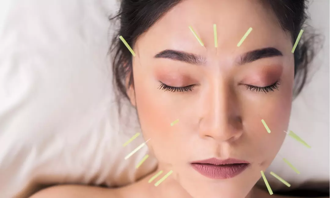 Relieve with One, Two or Three 60 Min Choice of Acupuncture Sessions