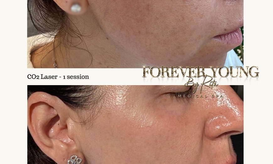 Image 8: Light or Intense Mode CO2 Laser Resurfacing Treatment for Full Face