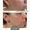 Image 8: Light or Intense Mode CO2 Laser Resurfacing Treatment for Full Face
