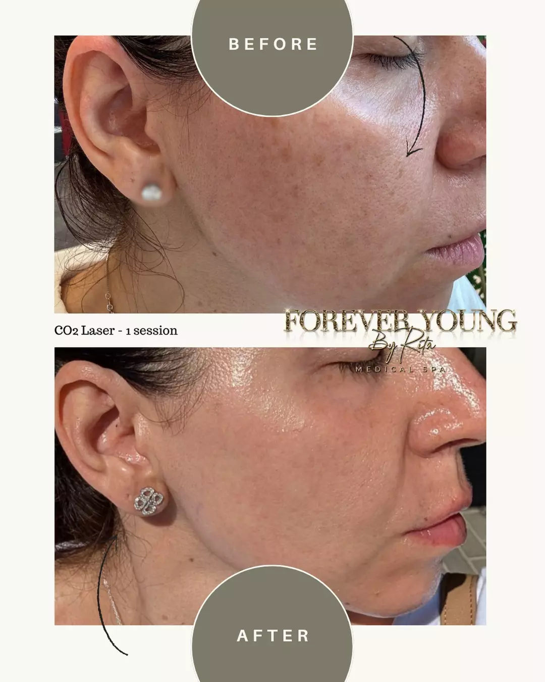 One Light or Intense Mode CO2 Laser Resurfacing Treatment for Full Face at Forever Young by Rita (Up to 55% Off)