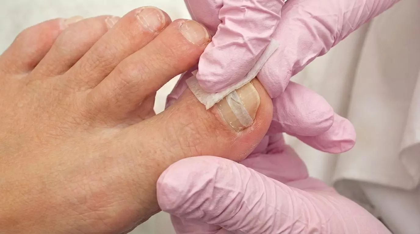 Solet Beauty Care Offers One or Three Laser Toenail Fungus Removal Treatment (Up to 56% Off) - Primary Image