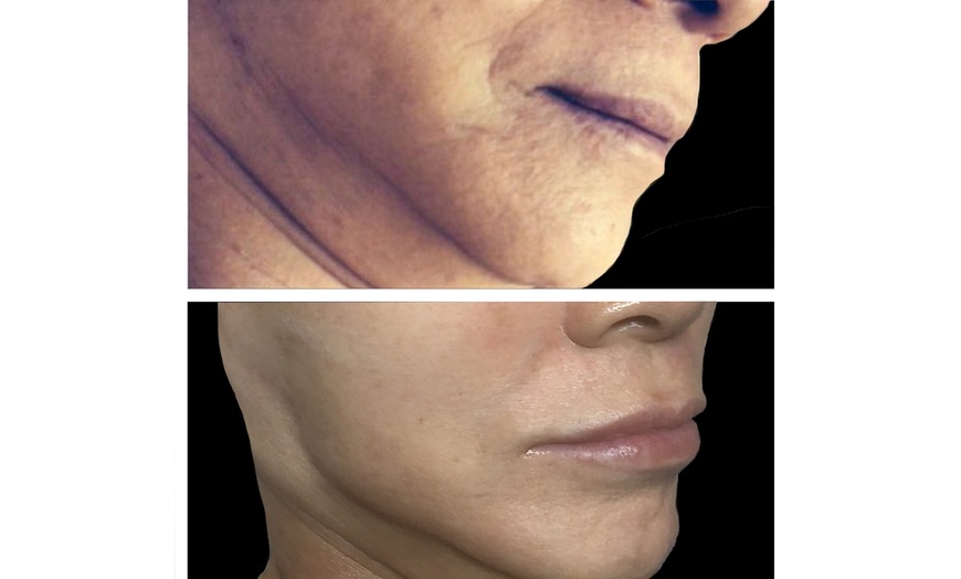 Image 4: One Microneedling Treatment with PRND, HA or Exosomes for Full Face