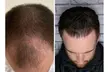 Full Hair Restoration with Up to 3000-Graft FUE Transplant for a Seamless, Natural Look (Up to 33% Off) - Second Medium