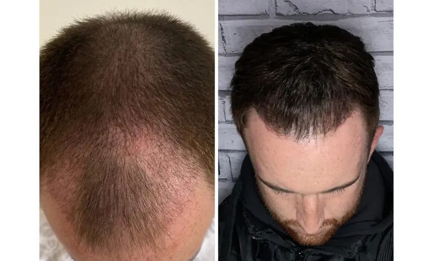 Image 6: Natural-Looking Hair Restoration with Up to 3000-Graft FUE Transplant