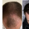 Image 6: Natural-Looking Hair Restoration with Up to 3000-Graft FUE Transplant