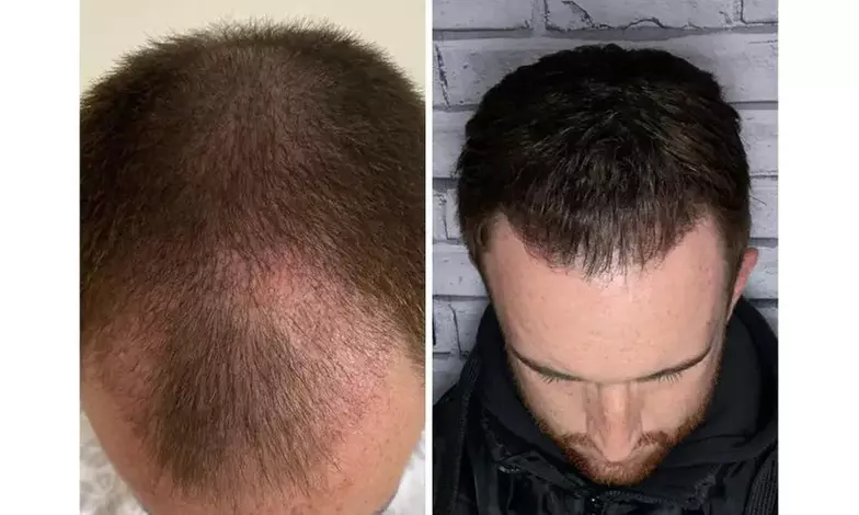 Natural-Looking Hair Restoration with Up to 3000-Graft FUE Transplant