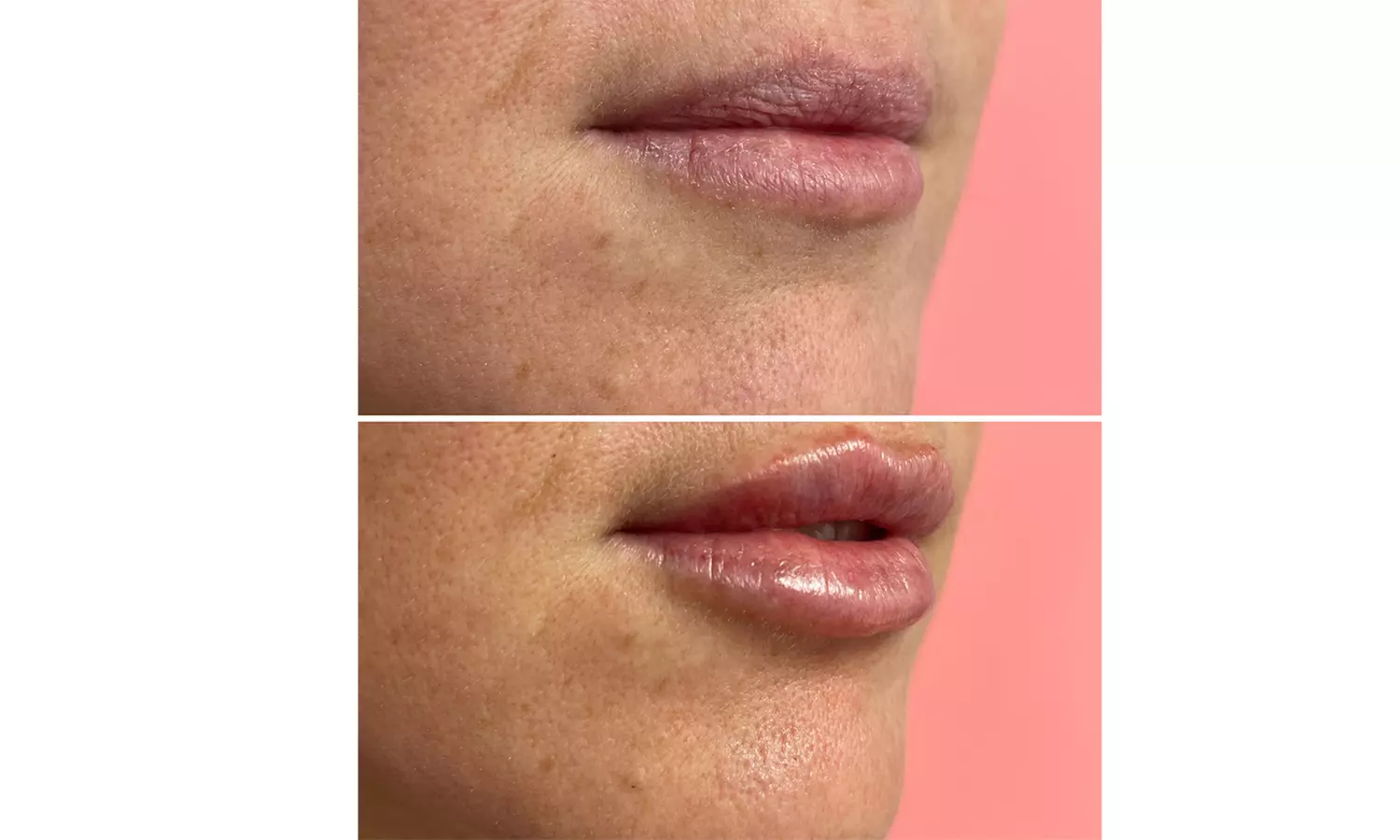 Half or Full Syringe of Versa Filler for Natural Enhancement