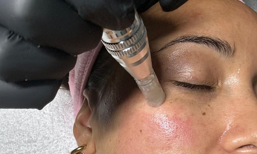 Image 5: Microneedling con vitaminas en rostro, cuello y escote para 1 persona