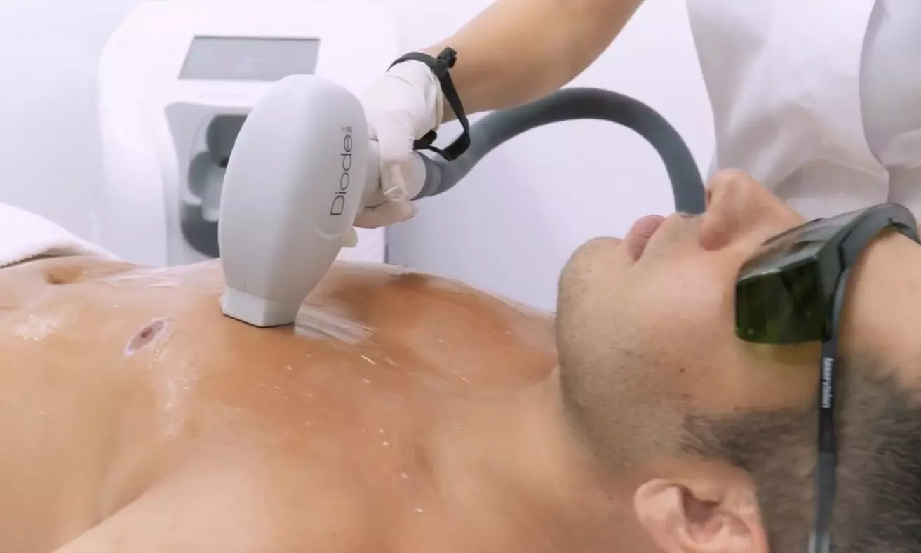 Laat ongewenste haartjes verdwijnen met 6 laserontharingsbehandelingen