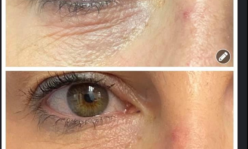 Image 5: Revanesse Versa Dermal Filler for Lips or Under Eyes