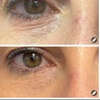 Image 5: Revanesse Versa Dermal Filler for Lips or Under Eyes