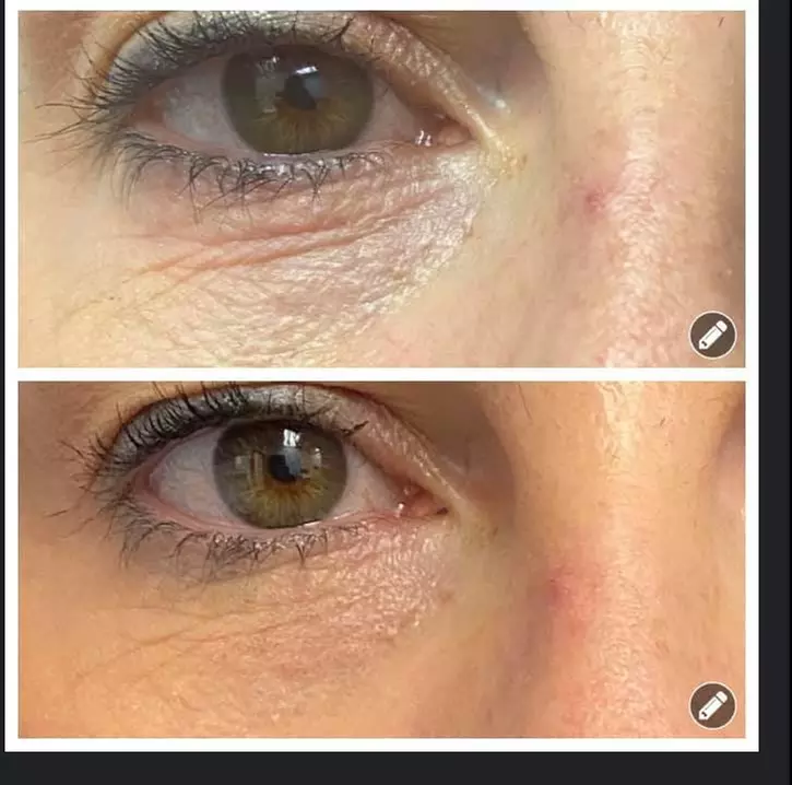 Revanesse Versa Dermal Filler for Lips or Under Eyes