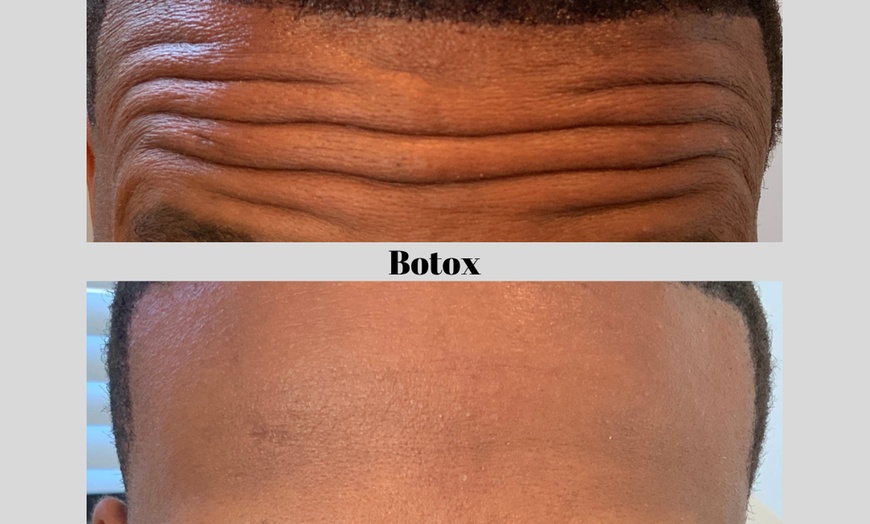 Image 5: Smooth Fine Lines & Wrinkles with Professional Botox Injections