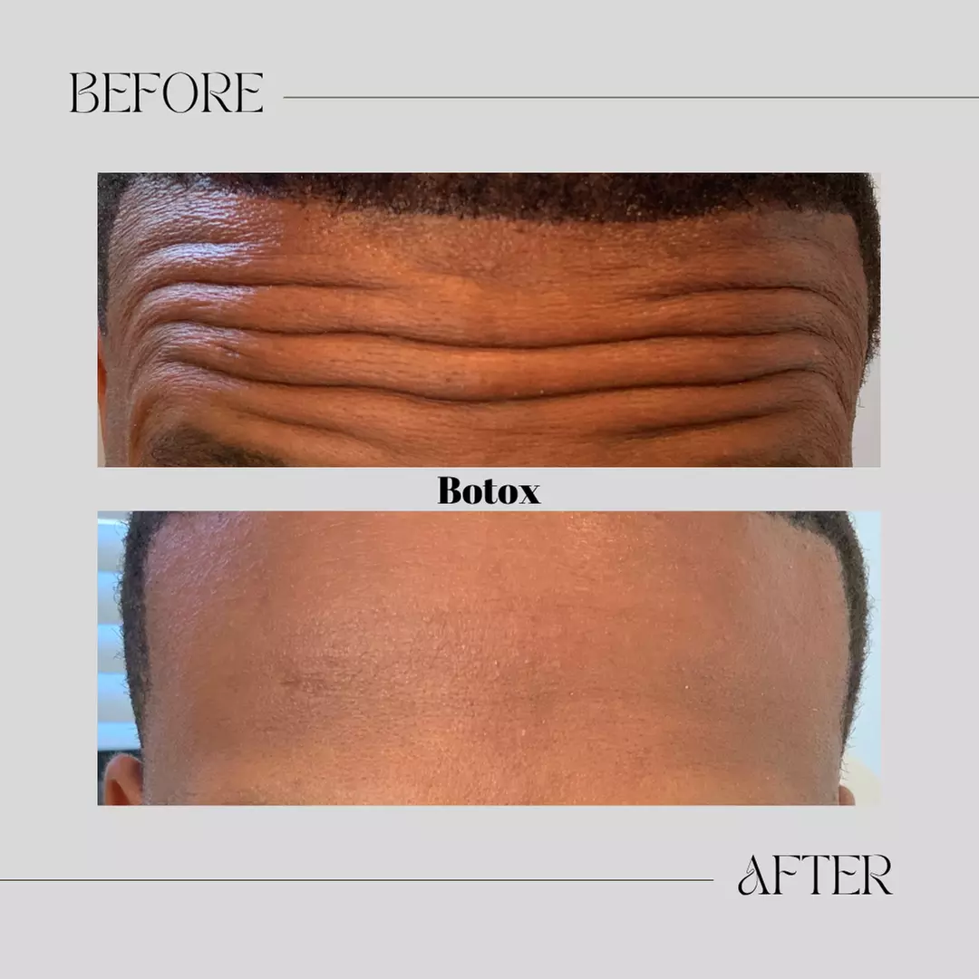 Smooth Fine Lines & Wrinkles with Professional Botox Injections