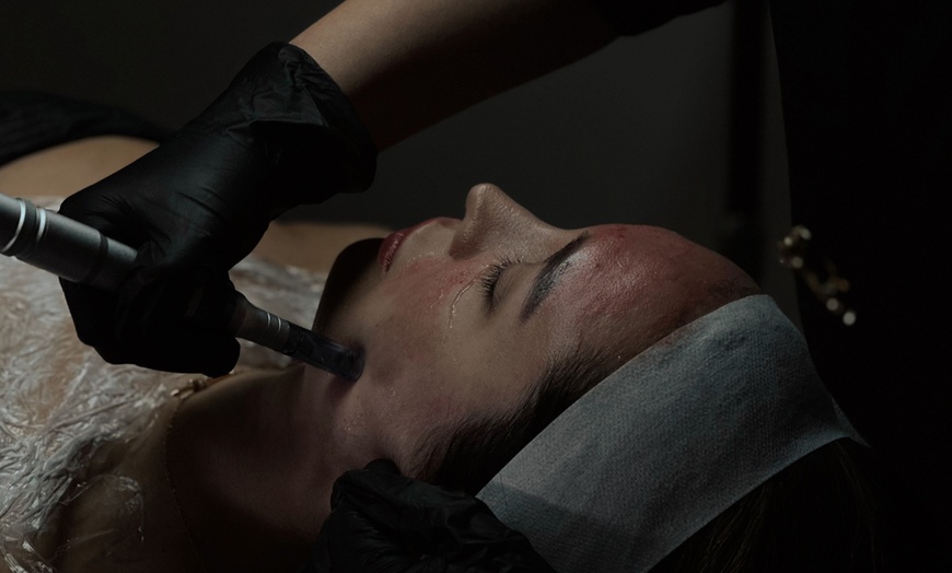 Image 3: One or Three Sessions Micro-needling w/ Glow Skin Booster (PDRN-Based)