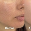 Image 3: Boost Collagen with 2 CC, 3 CC, 4 CC, or 5 CC of Sculptra Injections