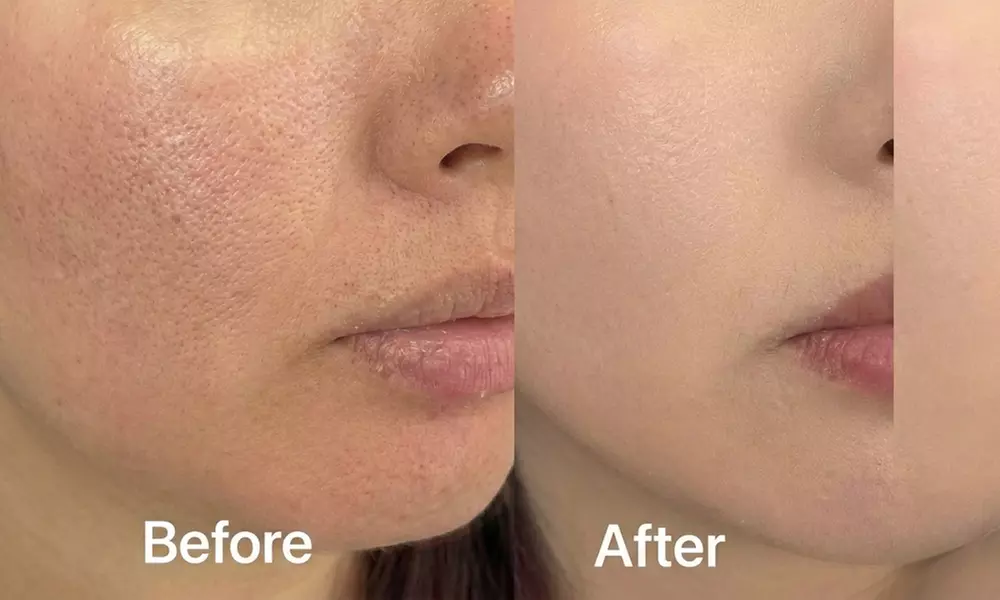 Boost Collagen with 2 CC, 3 CC, 4 CC, or 5 CC of Sculptra Injections