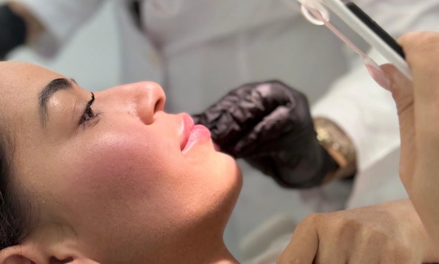 Image 2: Sesiones de tratamiento capilar con bioestimulación o mesoterapia