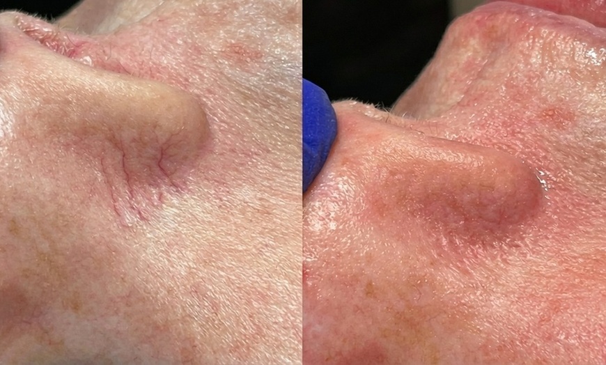 Image 5: Rejuvenate with One IPL Photo Facial for Face, Neck and Optional Chest