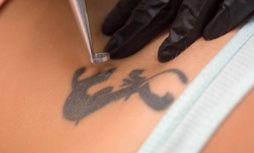 Image 9: 5 o 10 sesiones de eliminación de tatuajes