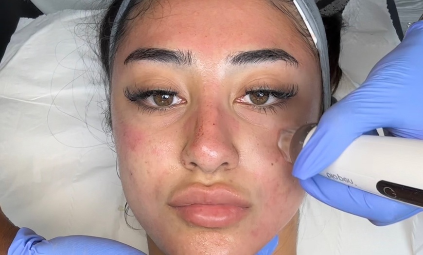 Image 6: Advanced Micro-needling w/ Luxury Hydrating Serums - Face and/or Neck